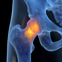 Injury_Hip